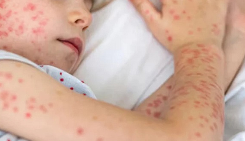 হাম ও হামের উপসর্গ নিয়ে আরো ৮ জনের মৃত্যু