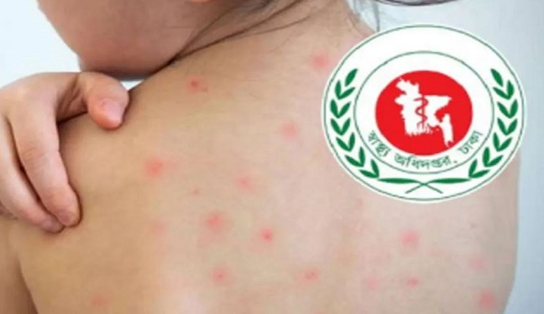 হামের উপসর্গ নিয়ে সারা দেশে আরো ৫ শিশুর মৃত্যু