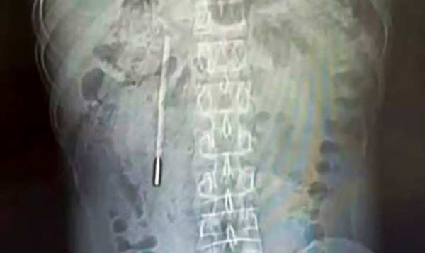 দুই দশক তরুণের পেটে ছিল থার্মোমিটার