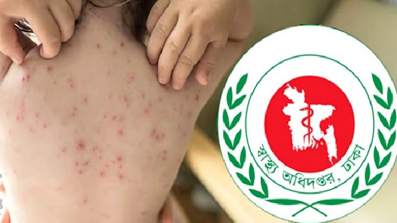 হামের উপসর্গ নিয়ে আরো পাঁচজনের মৃত্যু