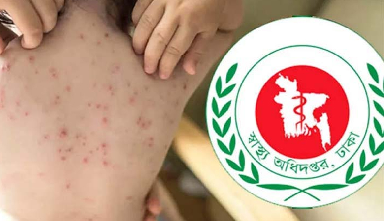 একদিনে হাম ও উপসর্গে আরো ১১ শিশুর মৃত্যু