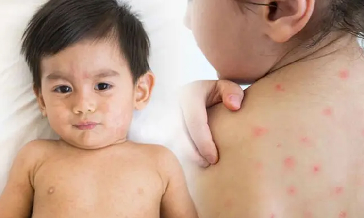 হামের লক্ষণগুলো জেনে নিন