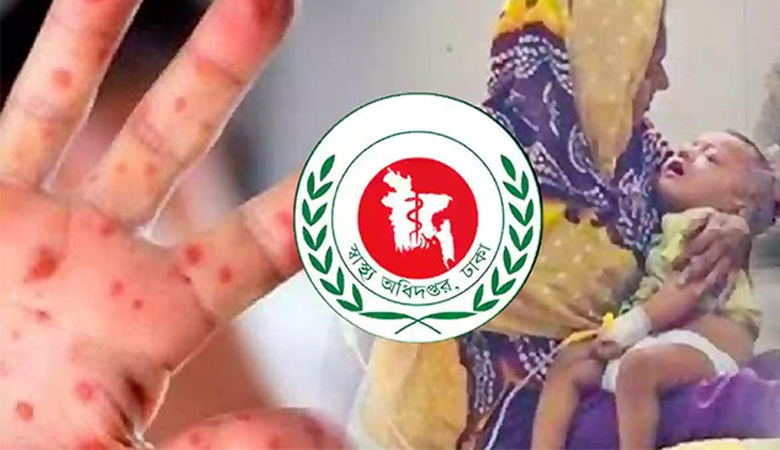 হাম ও উপসর্গ নিয়ে আরো ৬ জনের মৃত্যু