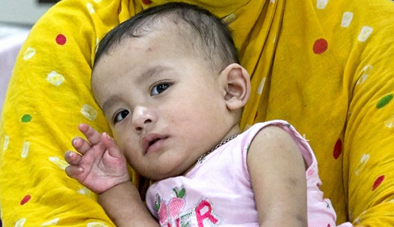 ২৪ ঘণ্টায় হাম ও উপসর্গ নিয়ে ১১ শিশুর মৃত্যু