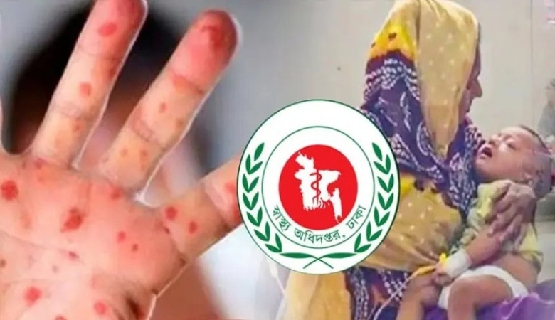 হাম ও উপসর্গে আরো ১৭ শিশুর মৃত্যু