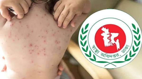 হামের উপসর্গে আরো দুই শিশুর মৃত্যু, মৃত ৮৮০