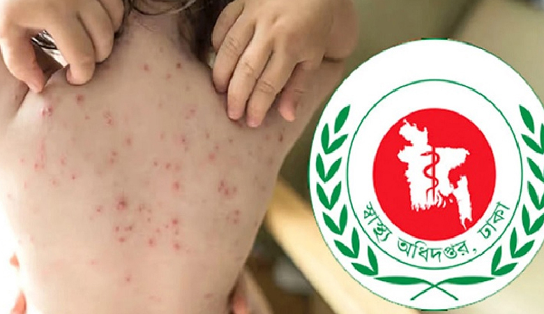 হামের উপসর্গ নিয়ে ৩ শিশুর মৃত্যু