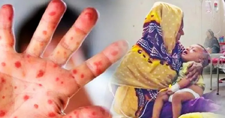 সুরক্ষাবলয়ে ফাটল: হামের কাছে কেন হার মানছে শিশুরা?