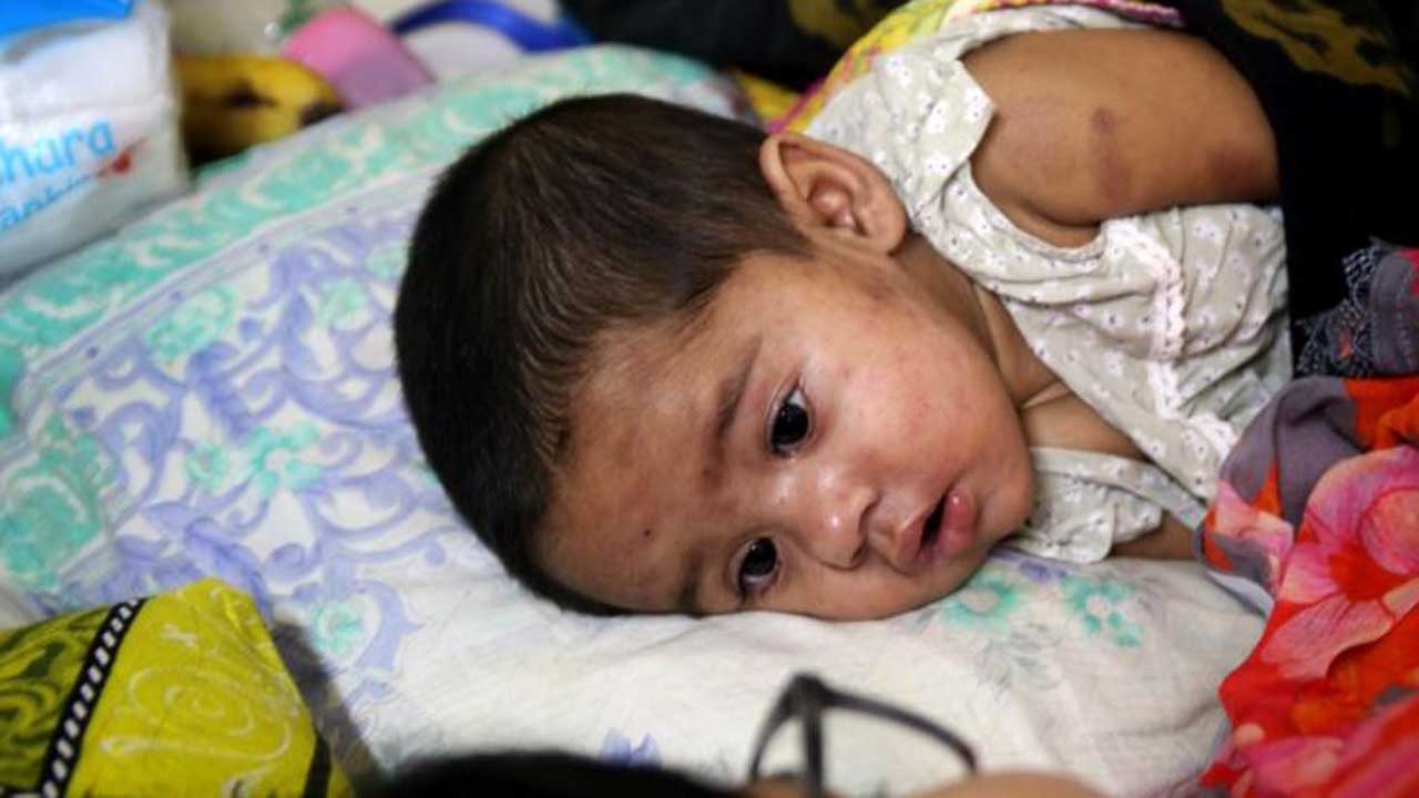 হামের উপসর্গে আরো তিন মৃত্যু, আক্রান্ত ৯৪৩